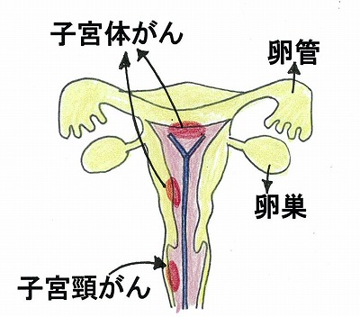 子宮体癌の場所
